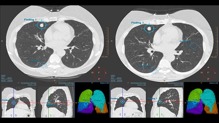  lung nodule assessment thumbnail