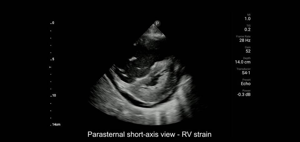 parasternal short-axis- view - rv strain