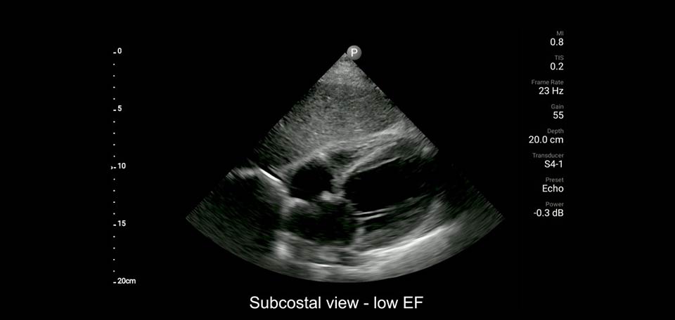subcostal view - low EF