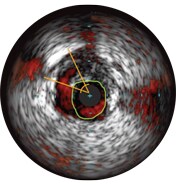 ivus interpretation assessment of edge dissection