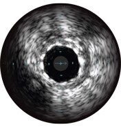 ivus interpretation assessment of stent expansion