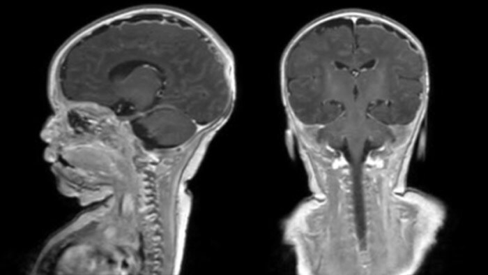 Rostral meningitis and arachnoiditis