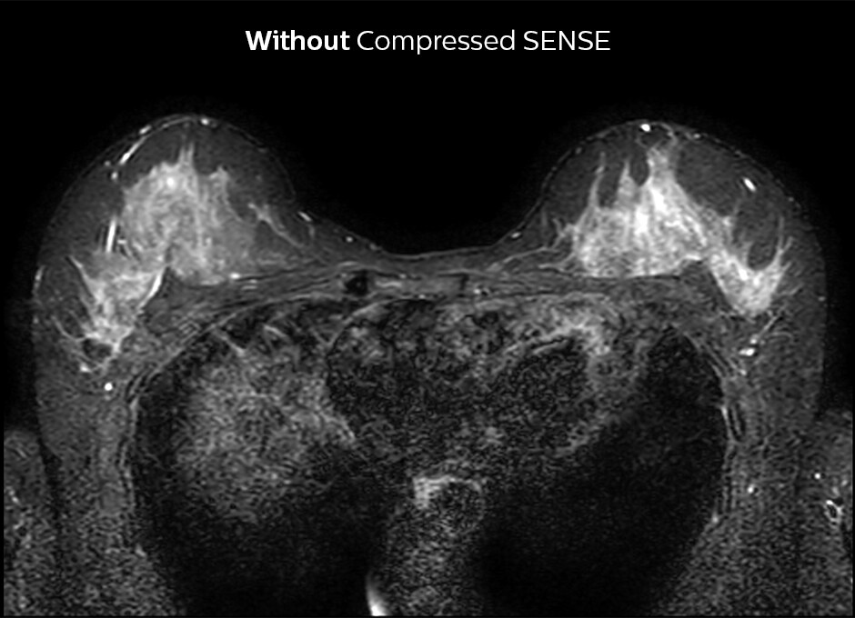 2D STIR breast WITHOUT Compressed SENSE