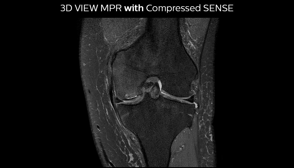3DVIEW PD SPAIR knee Compressed SENSE factor10 mprcor