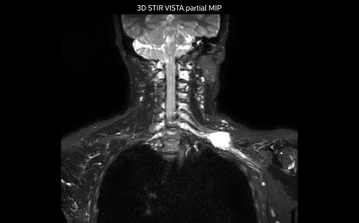 Whole body diffusion