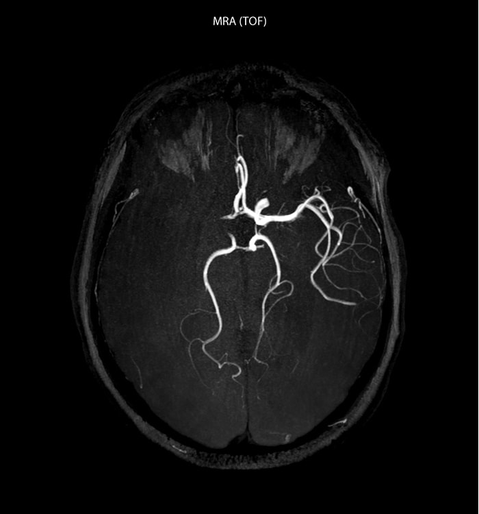 Acute ischemic stroke mra scan top view