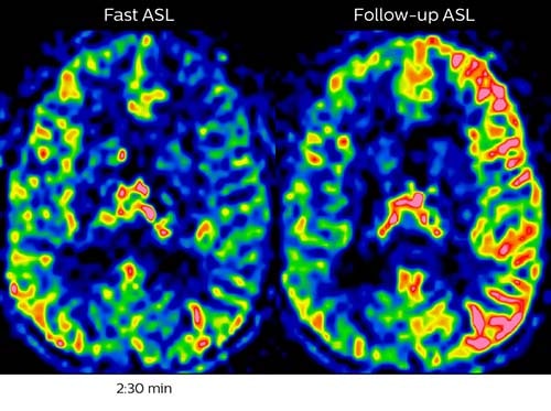 Acute right motor deficit and aphasia B