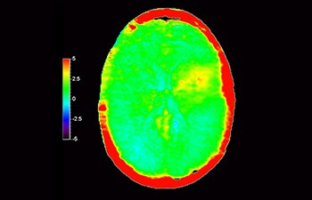 Brain lesion