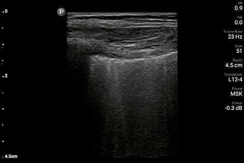 Lung image of the right chest