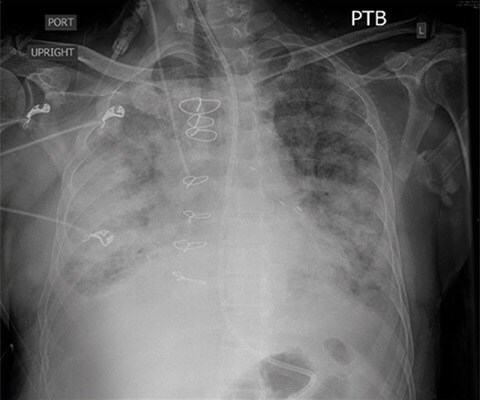 CXR