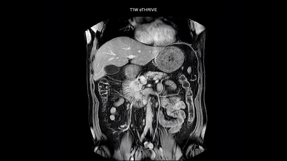 Bremen Case 4 Pancreas tumor 960px